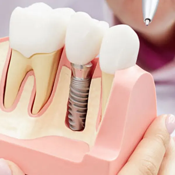 Dental Implants Melbourne